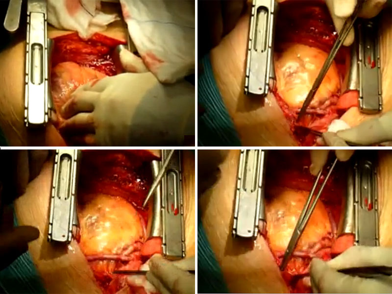 Heart Bypass open heart