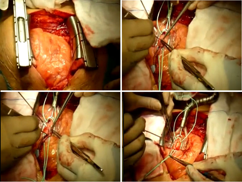 Heart Bypass heart 2